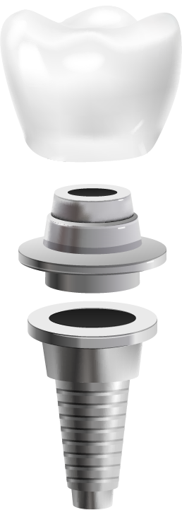 Meta Smile, Cabinet Stomatologic Meta Smile, implant, implant de calitate, reabilitare totala dentara, fast&fixed, protetica pe implanturi, Albire Profesionala AirFlow, Estetică dentară, Implantologie, Ordodonție invizibilă, Cosmetic Smile design, Tratamente fără durere