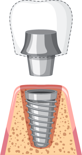 Meta Smile, Cabinet Stomatologic Meta Smile, implant, implant de calitate, reabilitare totala dentara, fast&fixed, protetica pe implanturi, Albire Profesionala AirFlow, Estetică dentară, Implantologie, Ordodonție invizibilă, Cosmetic Smile design, Tratamente fără durere
