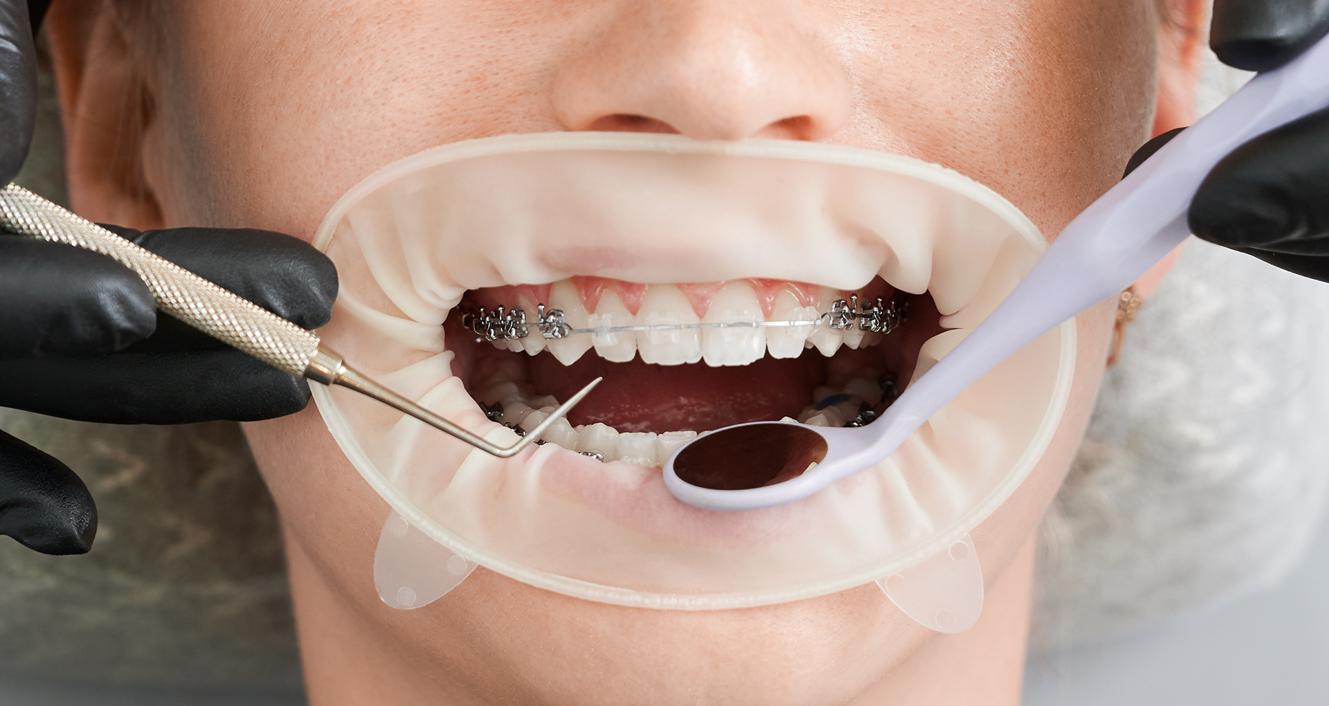 Meta Smile, Cabinet Stomatologic Meta Smile, implant, implant de calitate, reabilitare totala dentara, fast&fixed, protetica pe implanturi, Albire Profesionala AirFlow, Estetică dentară, Implantologie, Ordodonție invizibilă, Cosmetic Smile design, Tratamente fără durere